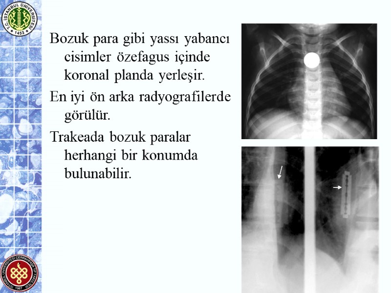 Bozuk para gibi yassı yabancı cisimler özefagus içinde koronal planda yerleşir. En iyi ön